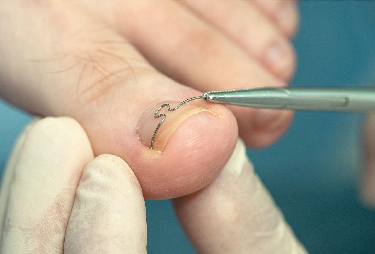 Nagelbeugel of spang behandeling voor het corrigeren van ingegroeide nagels en het sturen van nagelgroei