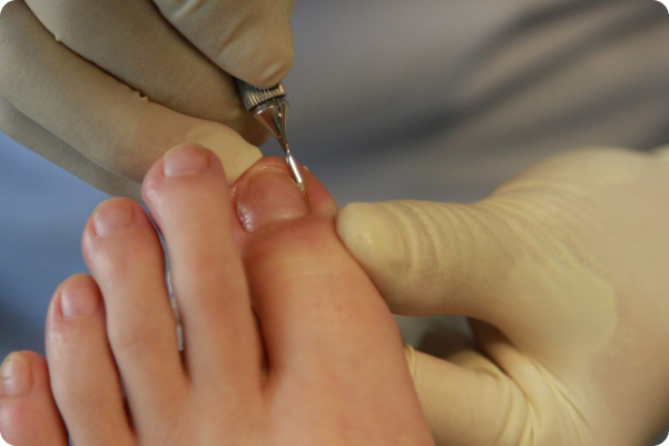Een close-up van een medisch pedicurebehandeling waarbij een specialist met handschoenen een gereedschap gebruikt om een teennagel te behandelen.
